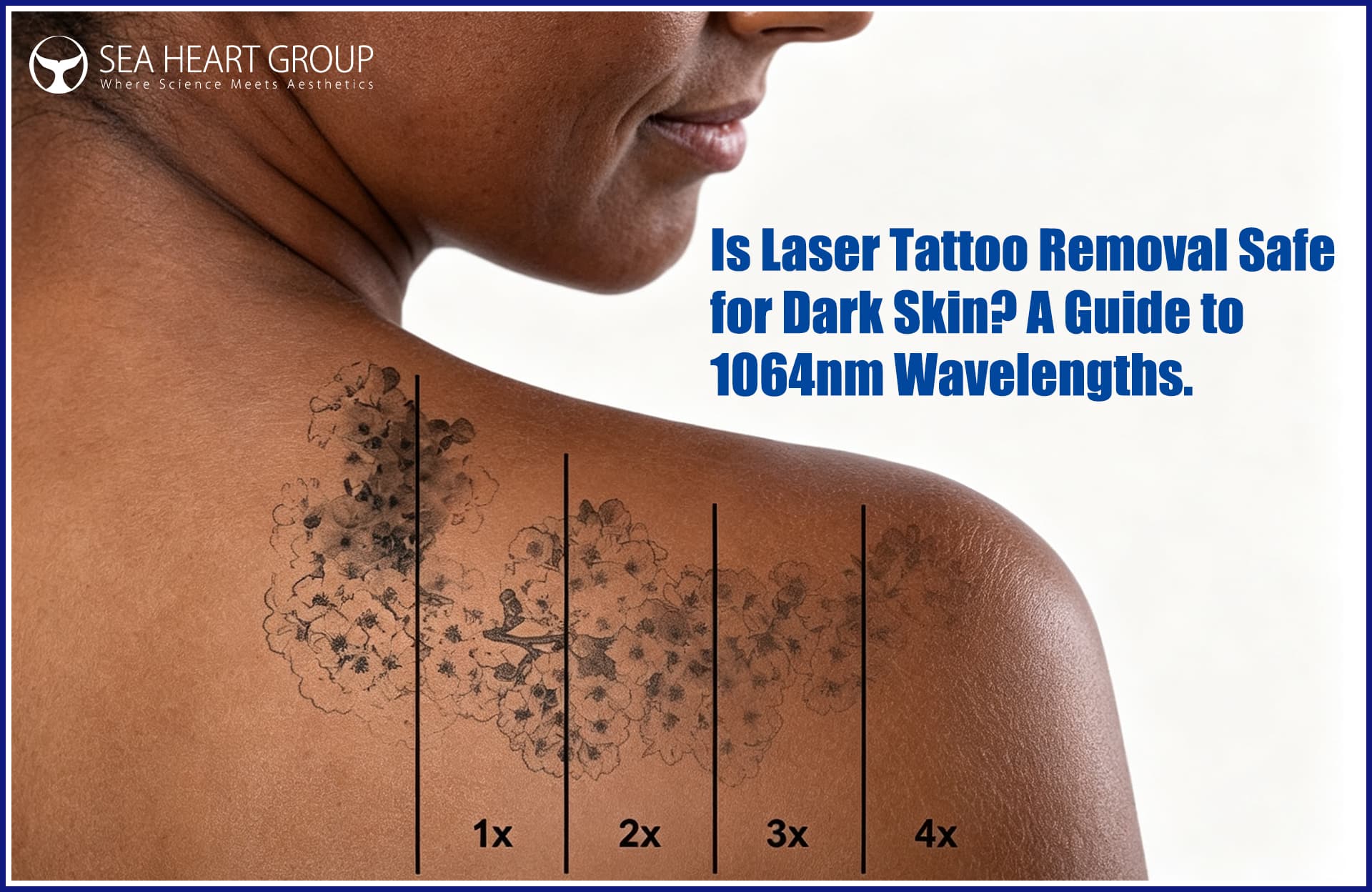 Is Laser Tattoo Removal Safe for Dark Skin? 1064nm Safety Guide