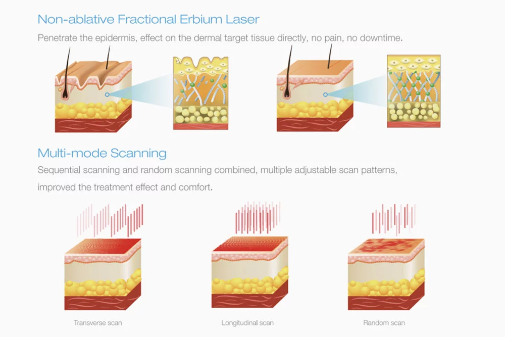 Renuva,1550nm & 2940nm Er:YAG Fractional Laser