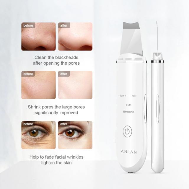 ANLAN Ultrasonic Skin Scrubber Deep Face Cleaning Machine Peeling Shovel Facial Pore Cleaner