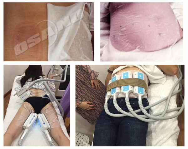 Osano Cryo Pad Antifreeze Membrane For Cryolipolysis Slimming Device Anti Freeze Membranes For Cryolipolysis Machine