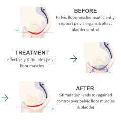 Osano Multifunctional Magchair Latest Pelvic Floor Machine Urinary Incontinence Pelvic Floor Machine