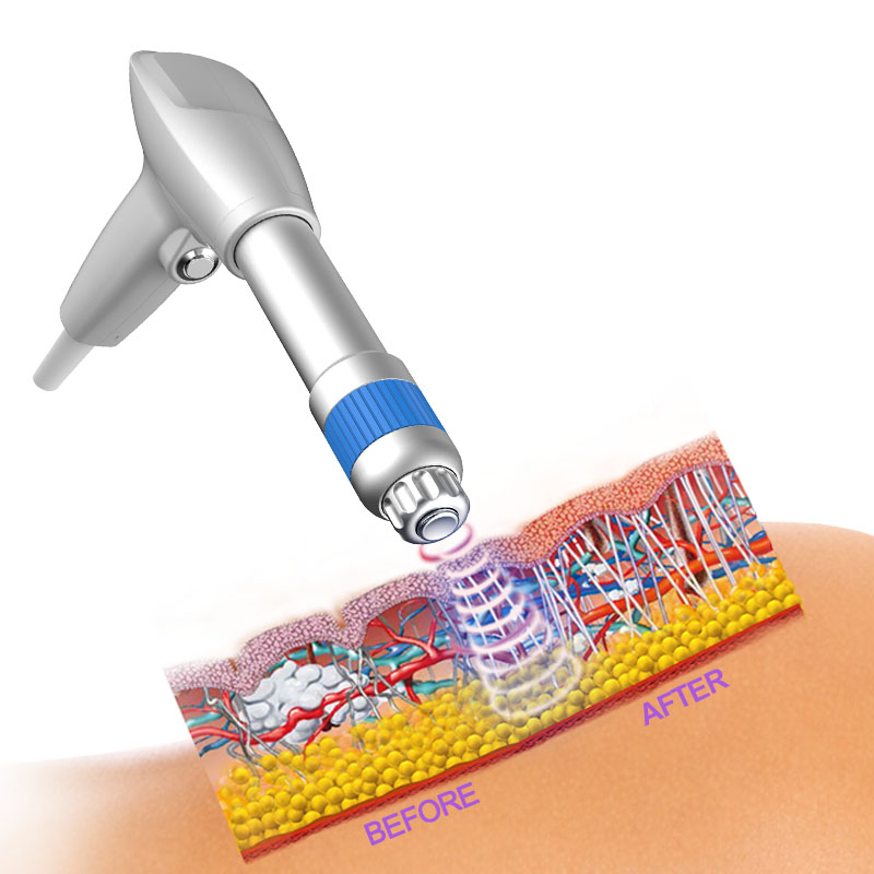 Shockwave therapy machine Acoustic Wave Therapy Radial Lipo Shock Wave