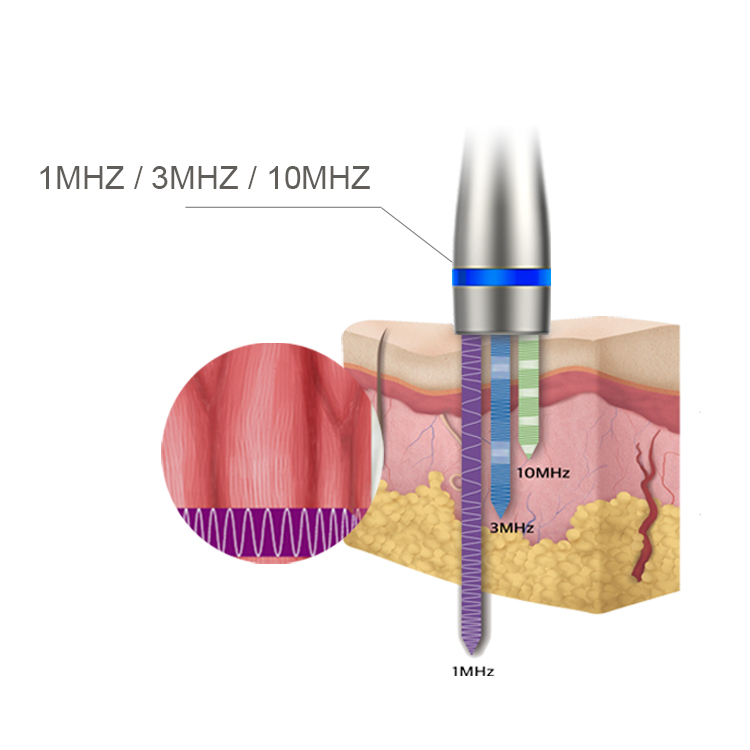 Acne Removal Machine Ultrasound Machine 10Mhz For Face Ultrasound Product Ldm Ultrasound
