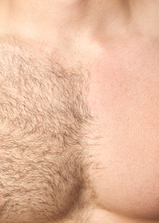Hair Removal