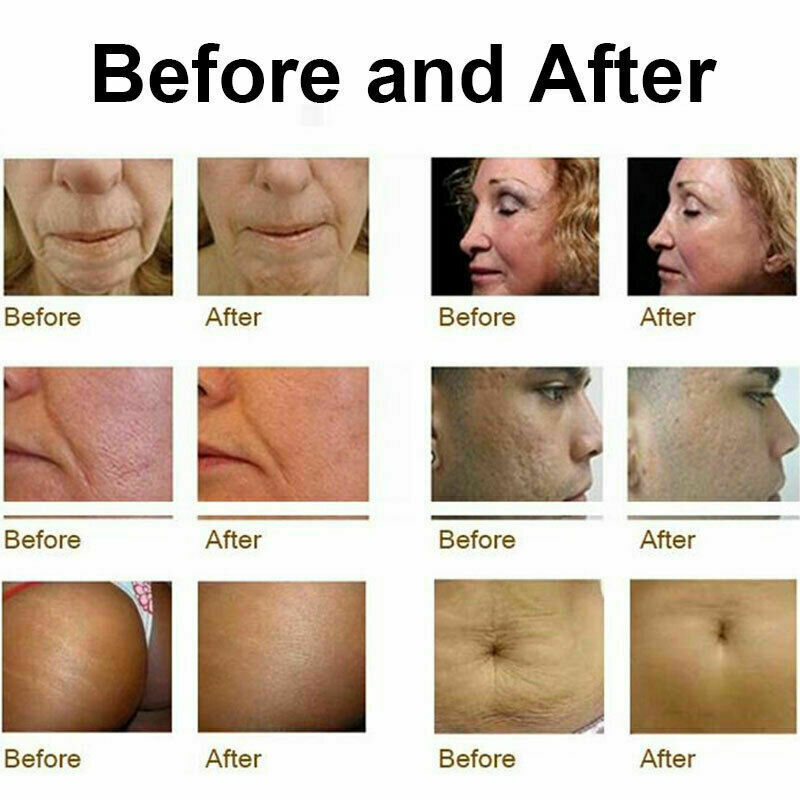 Portable 2in1 Microneedle Fractional RF Machine Micro Needle Equipment Skin Care Beauty Device Wrinkle Removal Face Lifting Tighten Shrink Pores Anti Stretch Marks