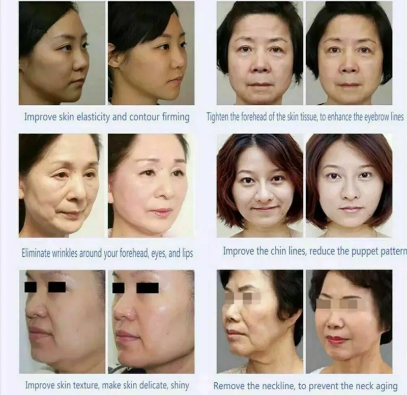 Professional Beauty Equipment 4D 12 Lines 20000 Shots High Intensity Focused Ultrasound Hifu Machine Skin SMAS Face Body Slimming Wrinkle Removal