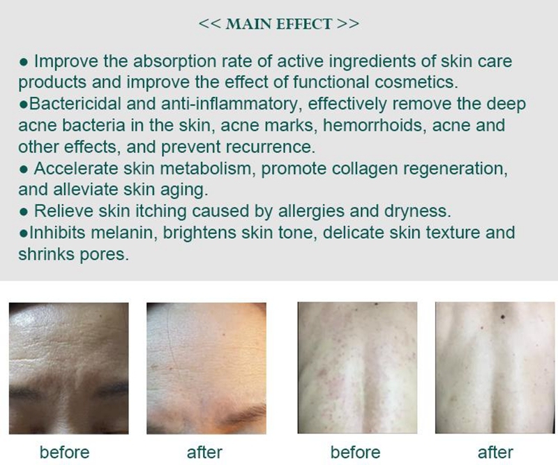 Ozone Plasma pen Eyes Lifting Face Skin Tightening Anti Acne Anti Bacterial