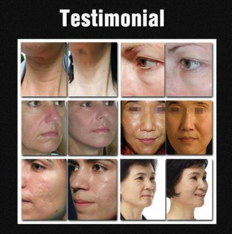 Intelligent Fractional RF Machine Radio Frequency Face Lift Skin Tightening Wrinkle Removal Dot Matrix Machine 3 Tips
