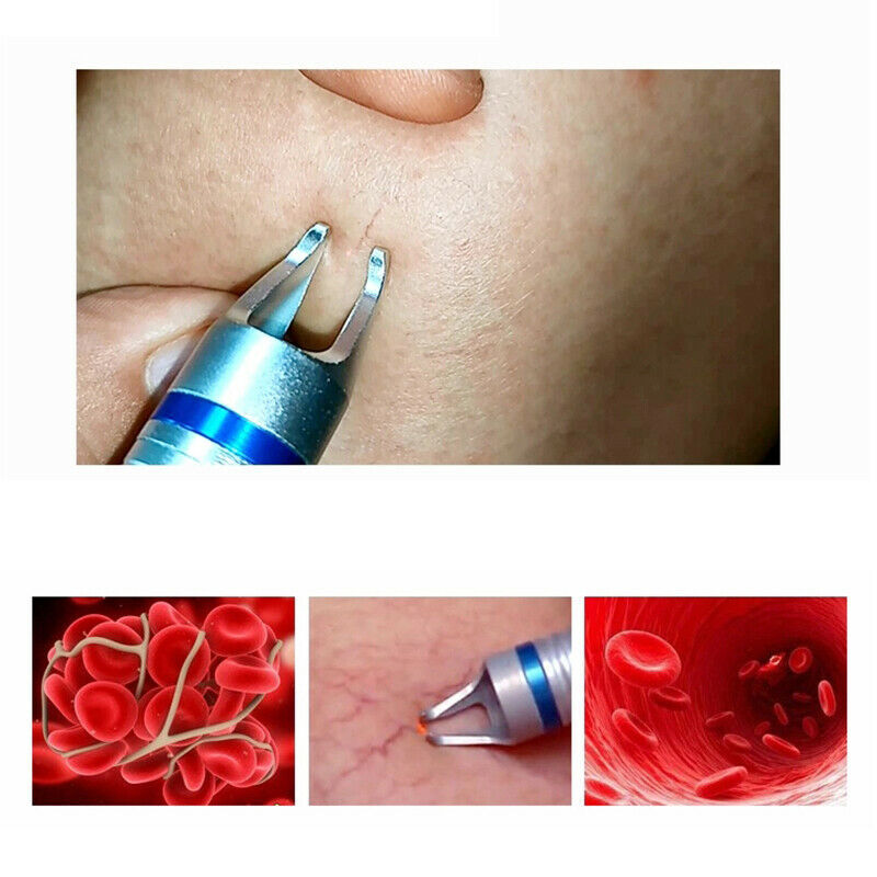 2in1 980nm Diode Laser Machine with Cold Hammer Facial Vascular Spider Vein Red Blood Vessels Removal