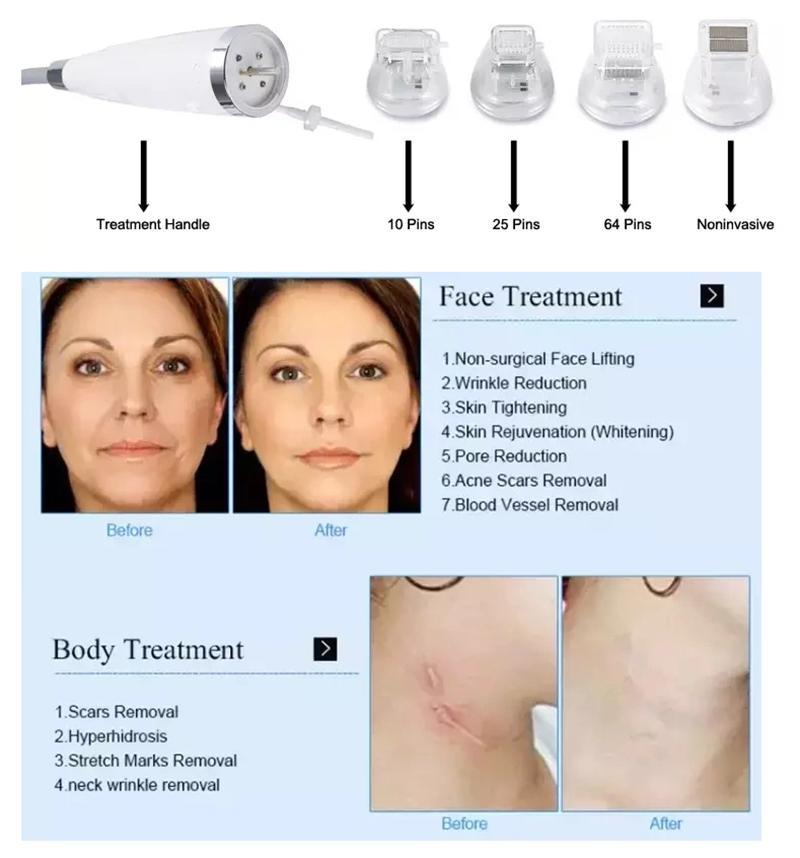 Portable 4D Hifu Machine Microneedle RF Fractional Face Lifting Hifu Machine Skin Tightening Stretch Mark Removal