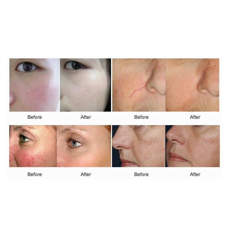 2in1 980nm Diode Laser Machine with Cold Hammer Facial Vascular Spider Vein Red Blood Vessels Removal