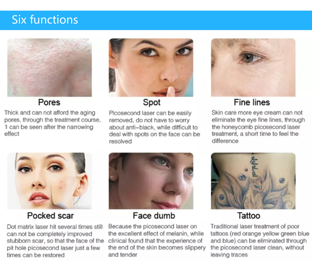 Professional Carbon Peel Laser Q Switched Nd Yag Laser Tattoo Removal Machine