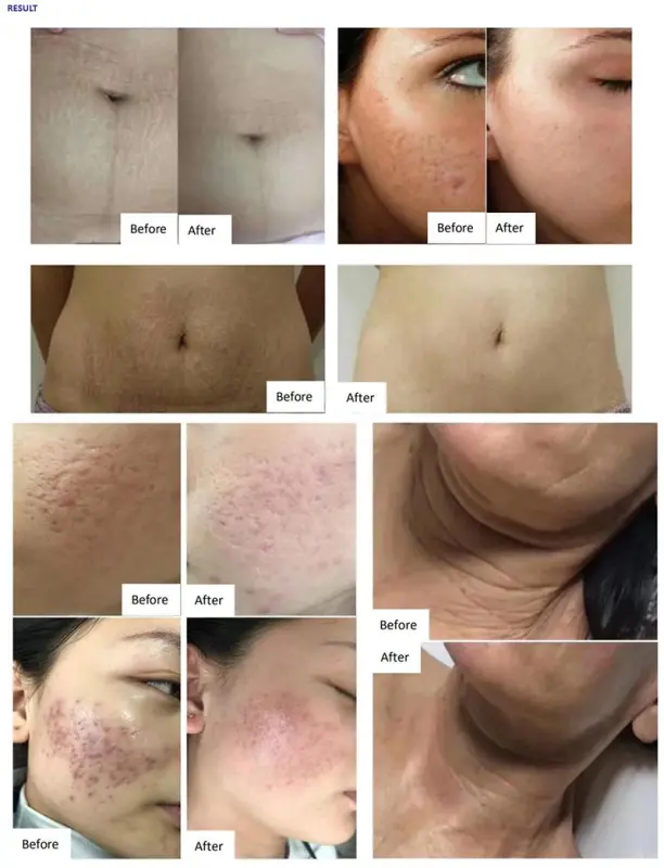 Portable 4D Hifu Machine Microneedle RF Fractional Face Lifting Hifu Machine Skin Tightening Stretch Mark Removal
