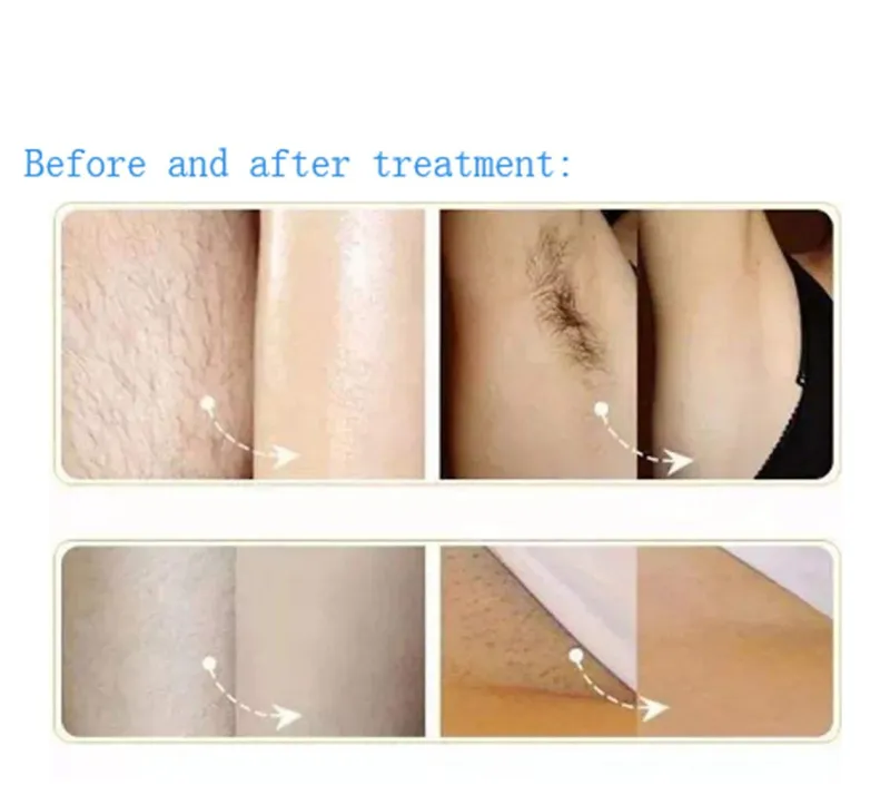 Professional Painless OPT IPL Laser Hair Removal Skin Rejuvenation Machine