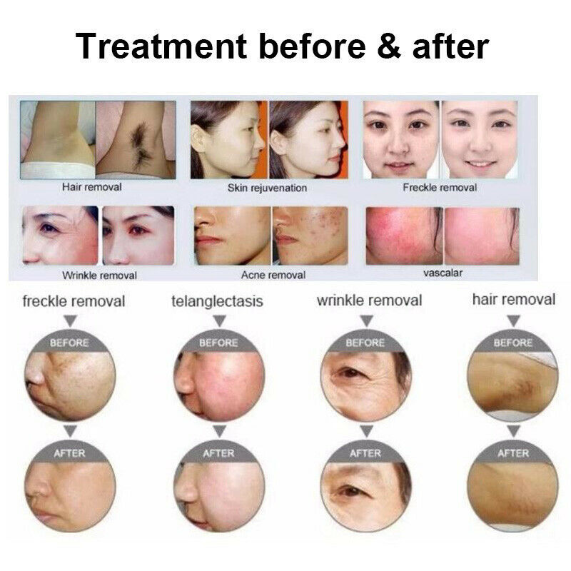 Professional Painless OPT IPL Laser Hair Removal Skin Rejuvenation Machine