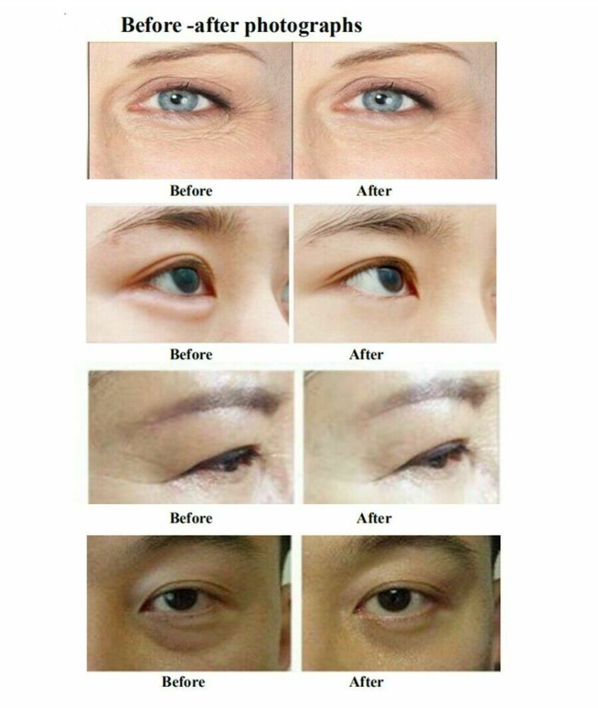 Portable Plasma Pen RF Machine for Eyes Lifting Anti Eye Bag Pattern Dark Circle