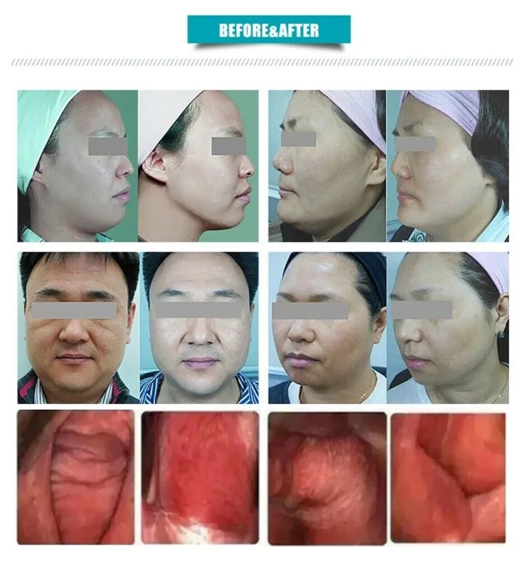 2IN1 4D HIFU Vmax Hifu 12 Lines High Intensity Focused Ultrasound Hifu Machine Skin SMAS Lifting Face Body Slimming Wrinkle Removal