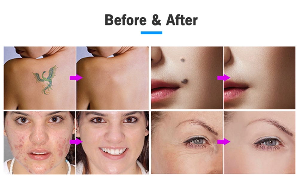 Professional 2 in 1 Ozone Plasma Mole Removal Pen LCD eyelid lifting Freckle Dark Spot Wart Remover Machine Tattoo Remaval Tool