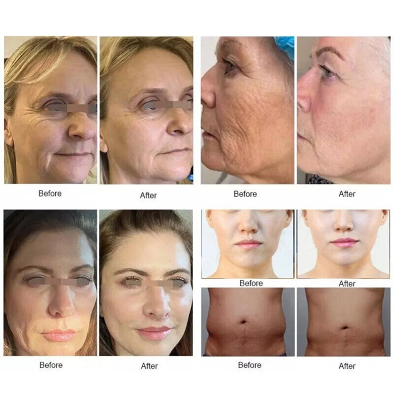 Hot Selling SMAS Lifting Machine 7D Face And Body Lifting Machines Wrinkle Removal 7D Hifu Machine