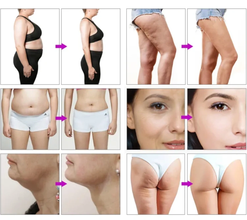 Comfortable treatment 5D ice hifu vmax smas face lifting frozen hi fu machine with skin cooling 2 in 1