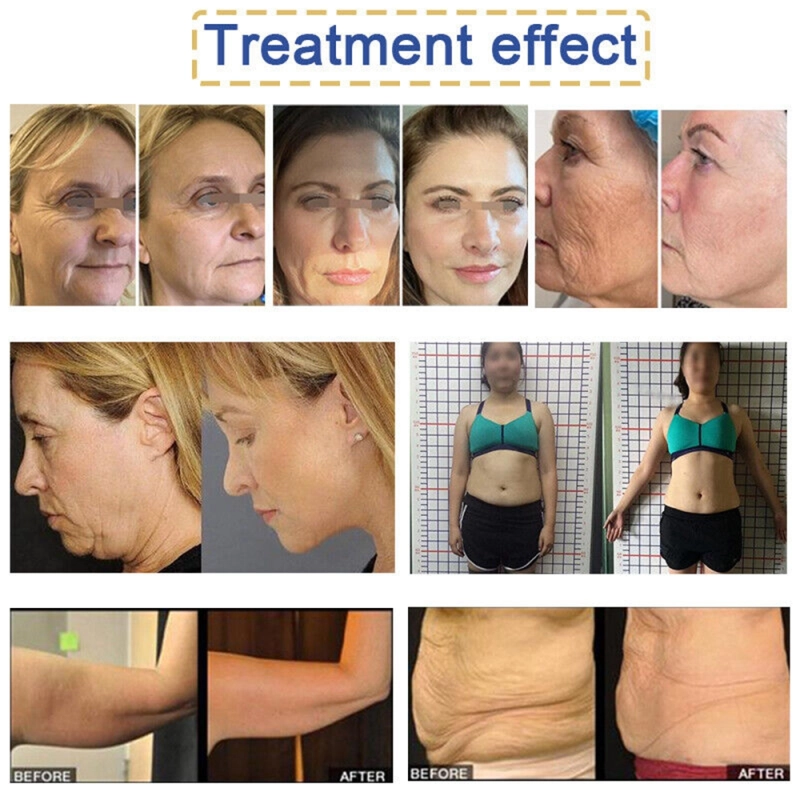 Portable 2in1 7d Hifu Machine Face Lifting Body Slimming Vaginal Tightening Machine Skin Care Rejuvenation