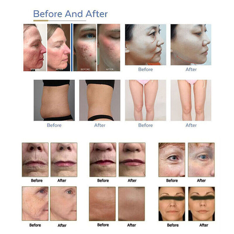 2IN1 7D Hifu and Microneedle Fractional RF Machine Anti Stretch Mark Fat Burn Skin Lifting Rejuvenation