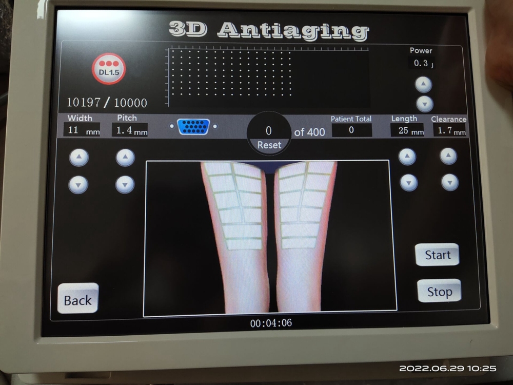 Portable 3D 4D HIFU Machine Face Lifting Wrinkle Removal Facial Machine Fat Reduction Body Slimming HIFU Machine