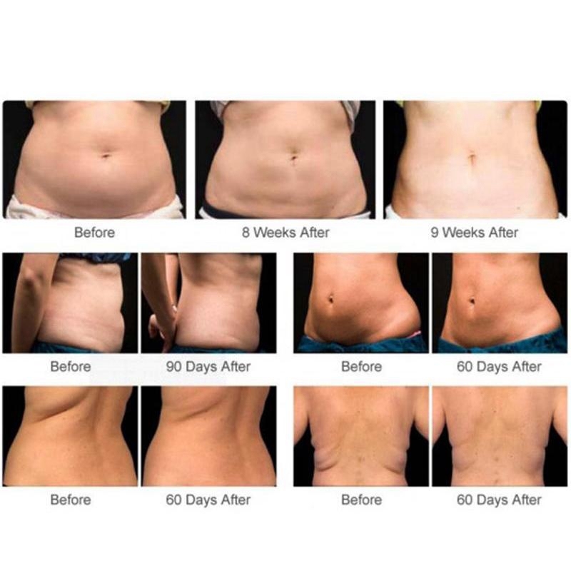 Portable Frozen Fat Freezing Slimming Machine Cooling System Fat Sculpting Body Shaping