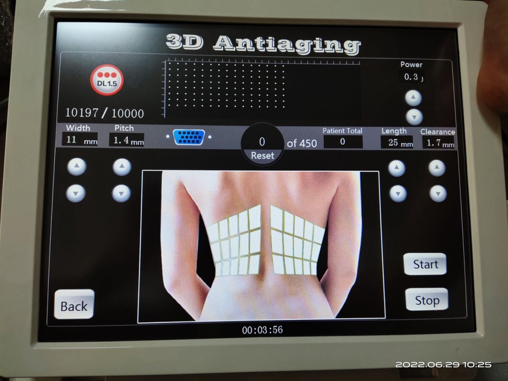 Portable 3D 4D HIFU Machine Face Lifting Wrinkle Removal Facial Machine Fat Reduction Body Slimming HIFU Machine