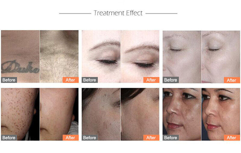 Picosecond Laser Tattoo Removal Machine Picosure Laser Skin Rejuvenation Pigment with 755nm+1064nm+532nm+1320nm