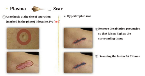Professional Ozone Plasma Pen 2 in 1 for Skin Tightening Plasma Scar Remover