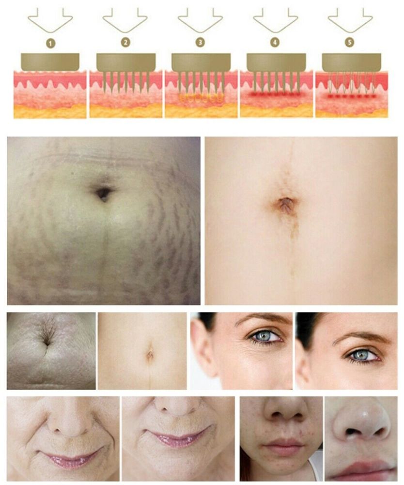 100pcs Insulated 10/25/64/nano Pins Replacement RF Microneedle Cartridges Skin Lifting Tighten Stretch Mark Scars Spots Removal