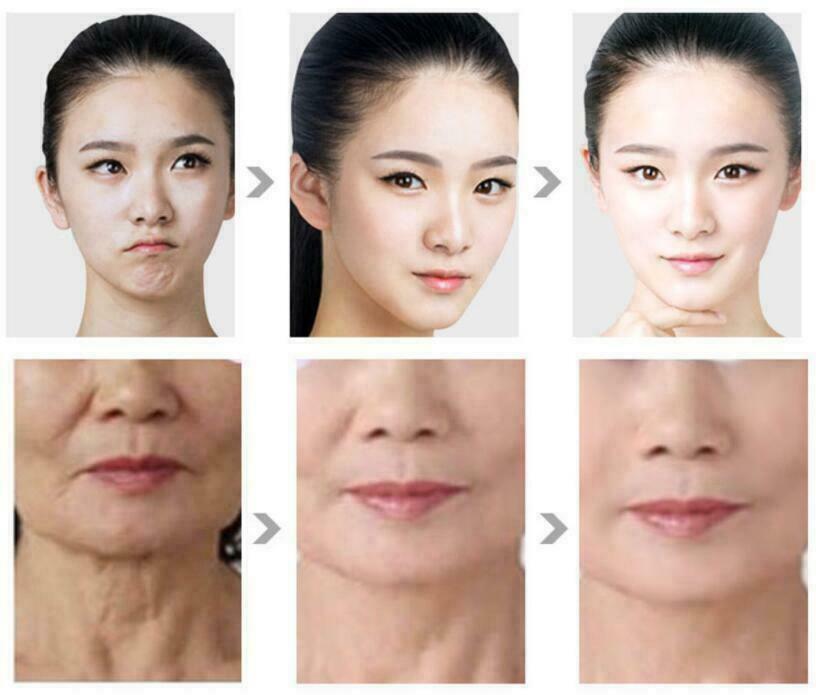 Portable Radar Vmax Carving Machine Anti-aging Face Sking Lifting Wrinkle Removal