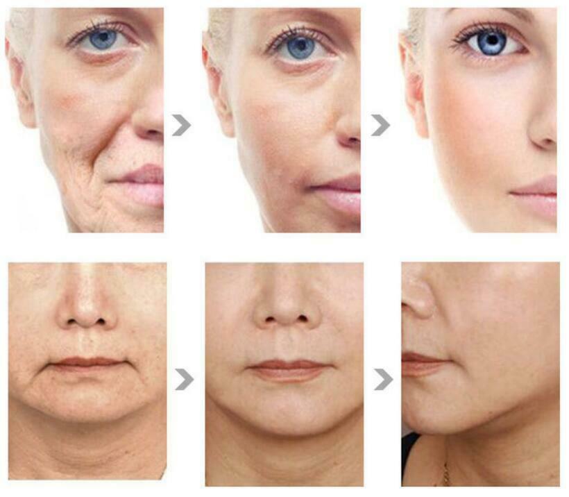 Portable Radar Vmax Carving Machine Anti-aging Face Sking Lifting Wrinkle Removal