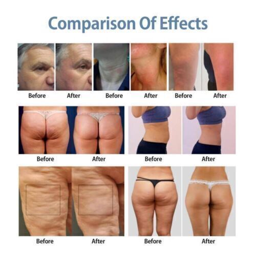 Pro Inner Ball Roller Endos phereing Therapy Cellulite Treatment Body Machine