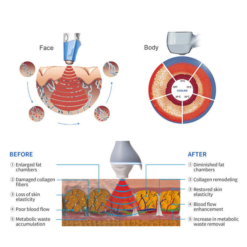 Portable 2 In 1 BTL Magic Ultrasound RF Skin Tighten Fat Removal Anti Cellulite Sculpting Beauty Machine Fat Reducing Weight Loss