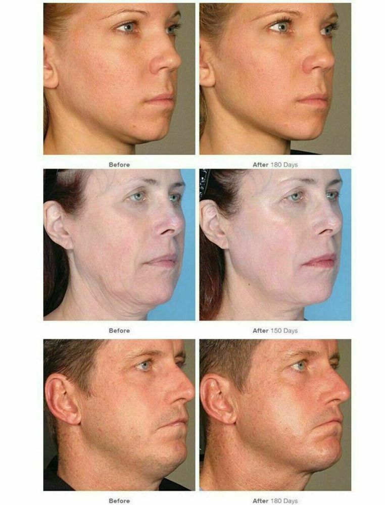 3IN1 4D HIFU Vmax Hifu 12 Lines High Intensity Focused Ultrasound Hifu Machine Vaginal Tighten Skin SMAS Lifting Face Body Slimming Wrinkle Removal