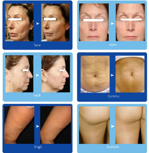 Portable 2 In 1 BTL Magic Ultrasound RF Skin Tighten Fat Removal Anti Cellulite Sculpting Beauty Machine Fat Reducing Weight Loss