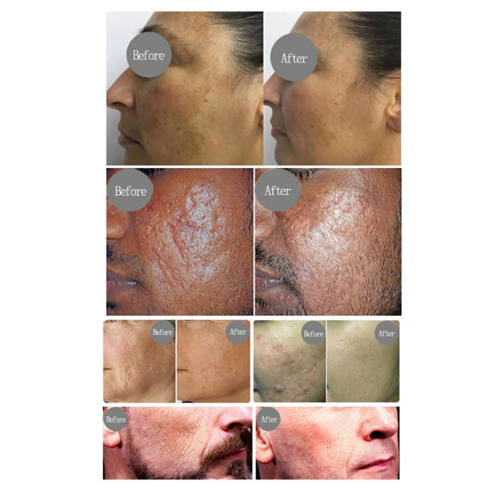 Tixel 400℃ Natural Thermal Fractional Skin Tightening Face Lifting Stretch Marks Removal Skin Care Rejuvenation