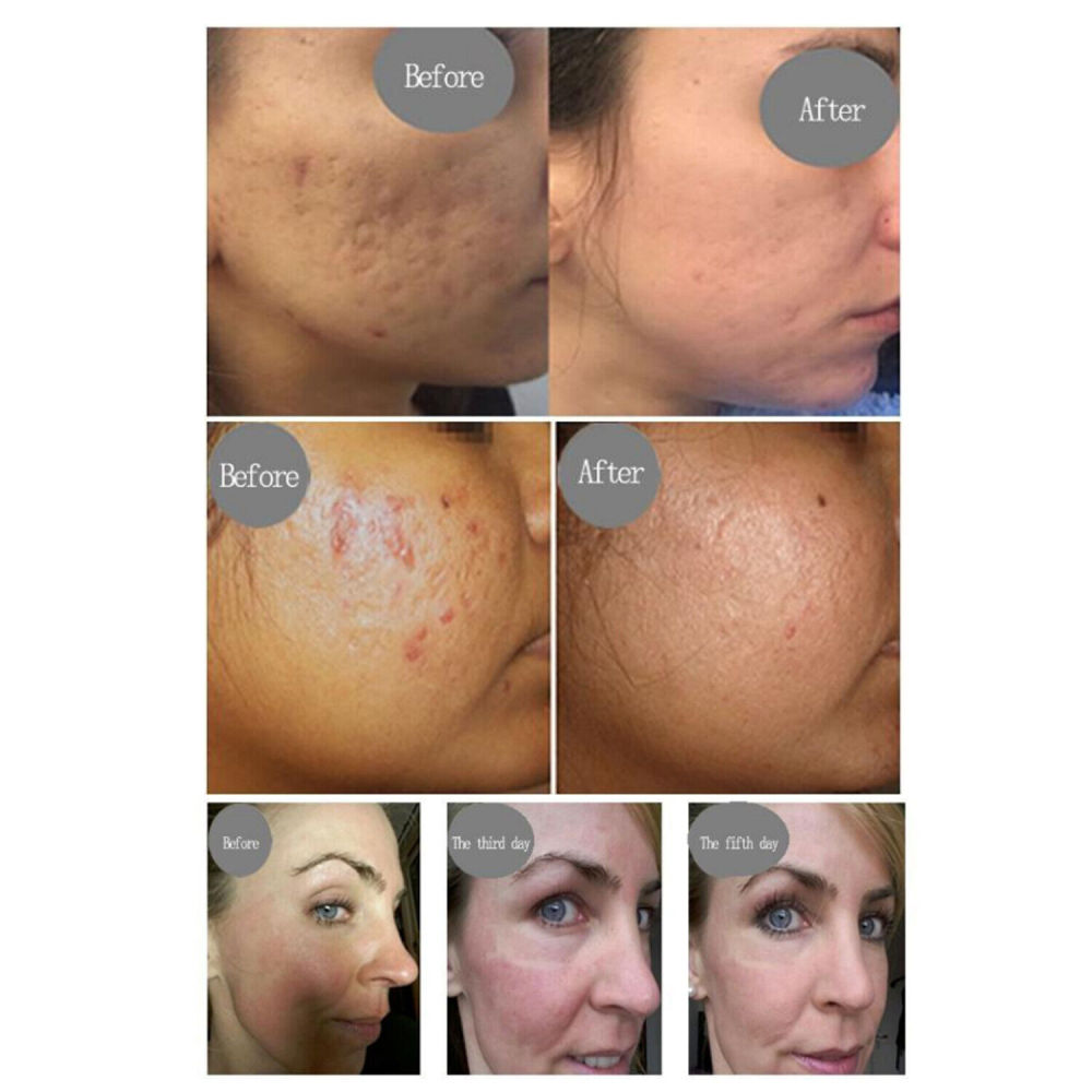 Tixel 400℃ Natural Thermal Fractional Skin Tightening Face Lifting Stretch Marks Removal Skin Care Rejuvenation