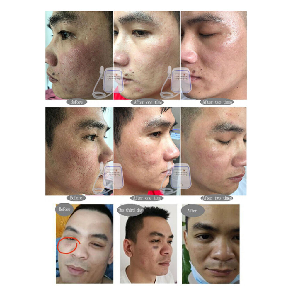 Tixel 400℃ Natural Thermal Fractional Skin Tightening Face Lifting Stretch Marks Removal Skin Care Rejuvenation
