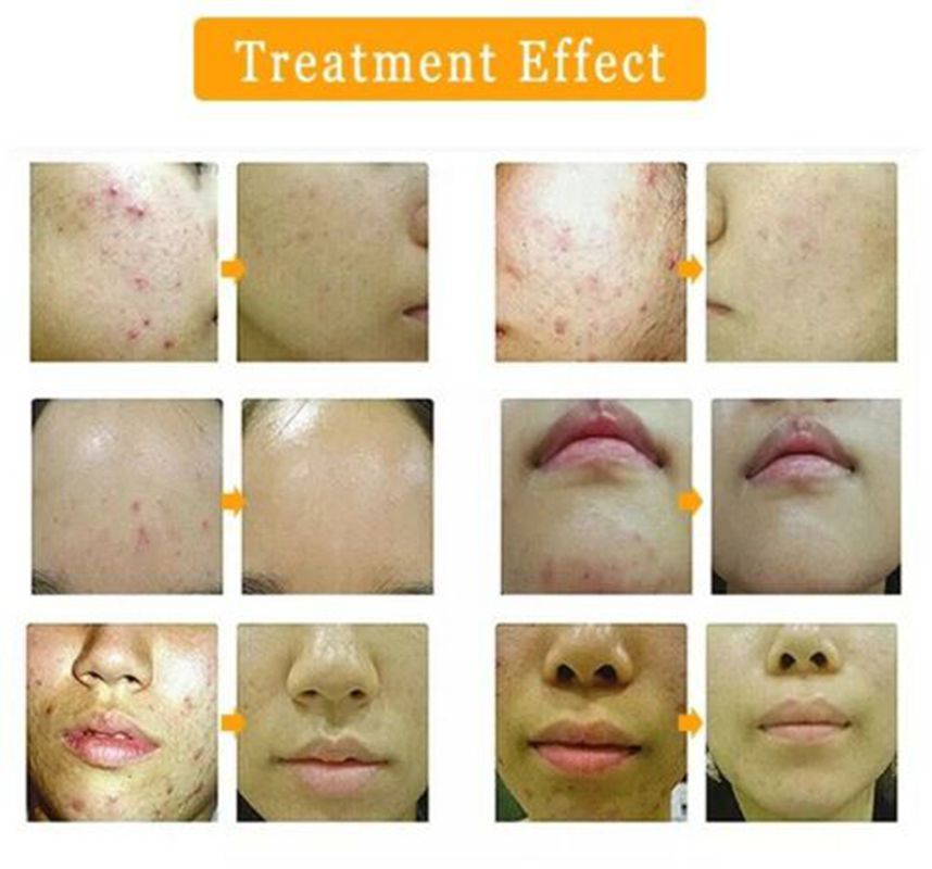 Korea Technology Acacia Acne Treatment Device Professional Acne Removal RF Machine