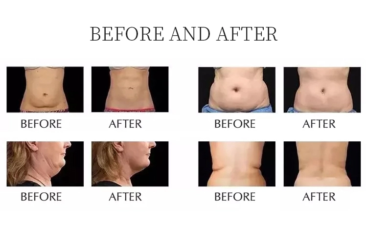 Newest 10 in 1 lipo laser liposuction rf lipo 80k cavitation slimming machine 80k lipocavitation lipolaser