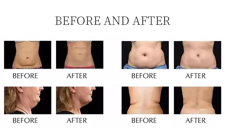 Newest 10 in 1 lipo laser liposuction rf lipo 80k cavitation slimming machine 80k lipocavitation lipolaser