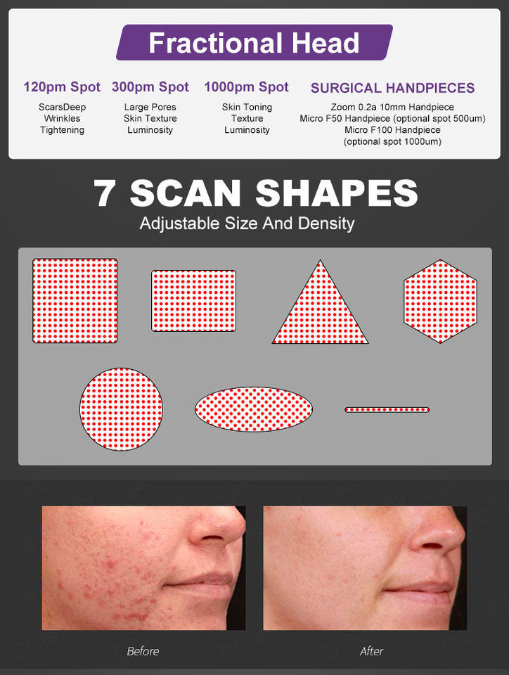 High Quality Fotona 4D System Fractional CO2 Laser Equipment CO2 Fractional Laser Machine For Sale