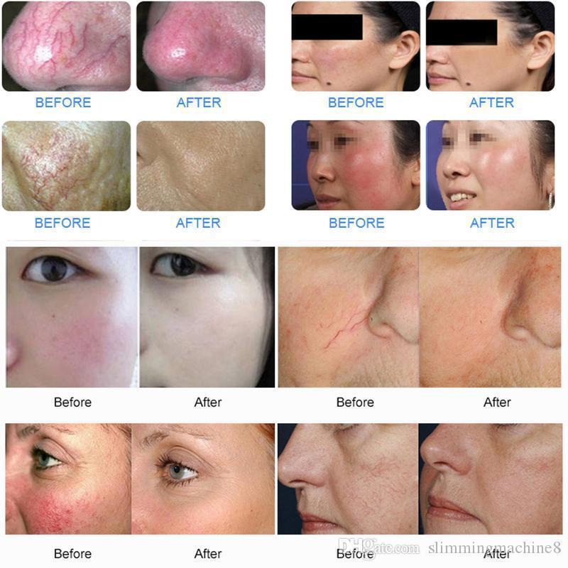 Professional 5 IN 1 980nm Diode Laser Vascular Spider Veins Removal Nails Fungus Machine