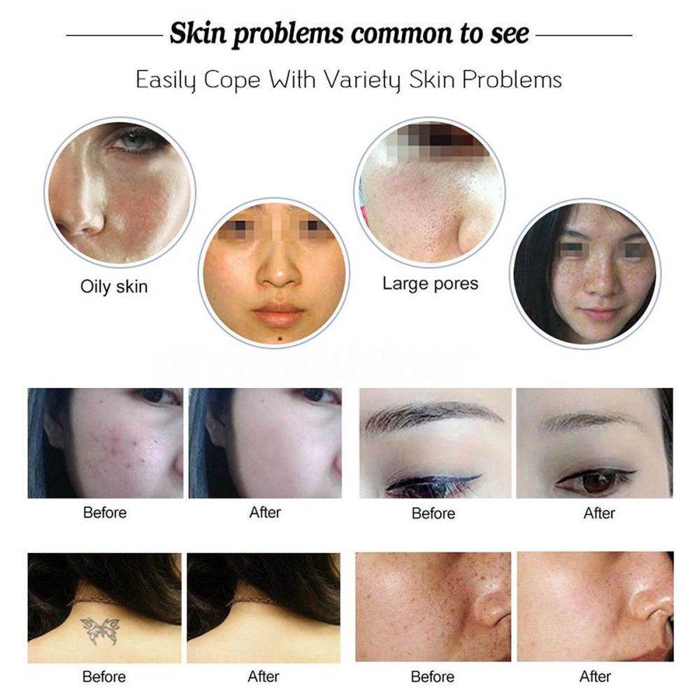 Handheld Mini Tattoo Removal Machines Neatcell poiniter Laser Picosecond Pen Freckle Mole Dark Spot Pigment Acne scars remover Beauty Device