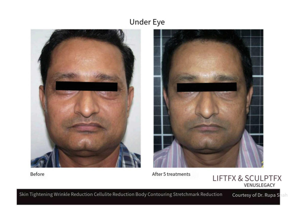 Professional Venus Body Sculpt Slimming Machine