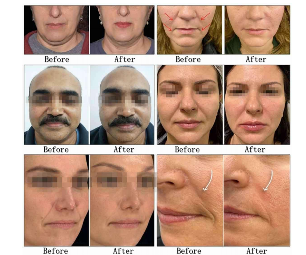 2in1 Single Point ICE Vmax Morpheus M8 Freezing Machine Face Skin Lifting Body Tighten Body Shape for Beauty Salon