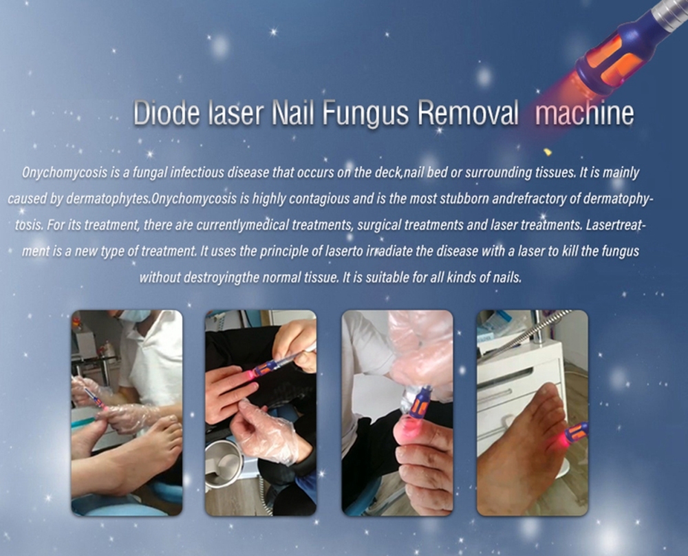980nm Nail Fungus Removal Diaode Laser Therapy Instrument Machine 30W